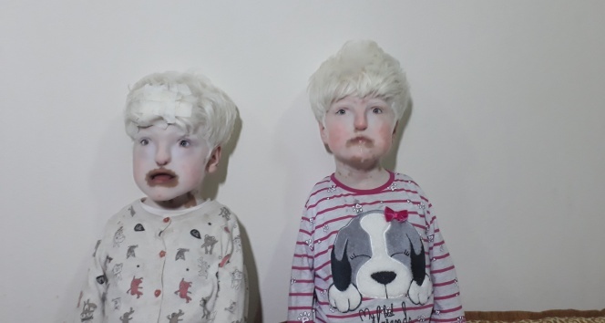 Albino kardeşler yardım bekliyor | Albino hastalığı nedir?