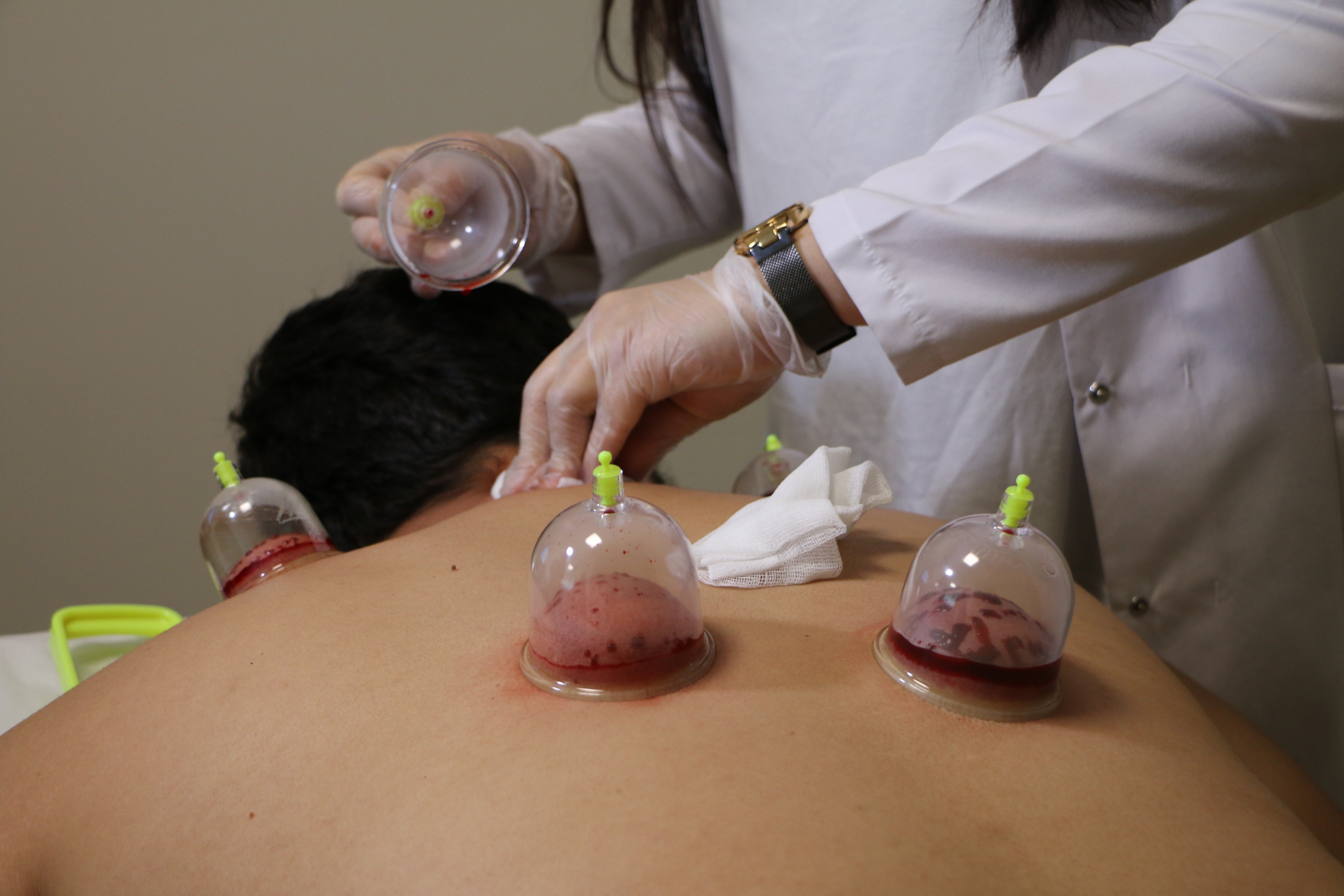 Soğuk hava migrenine hacamat