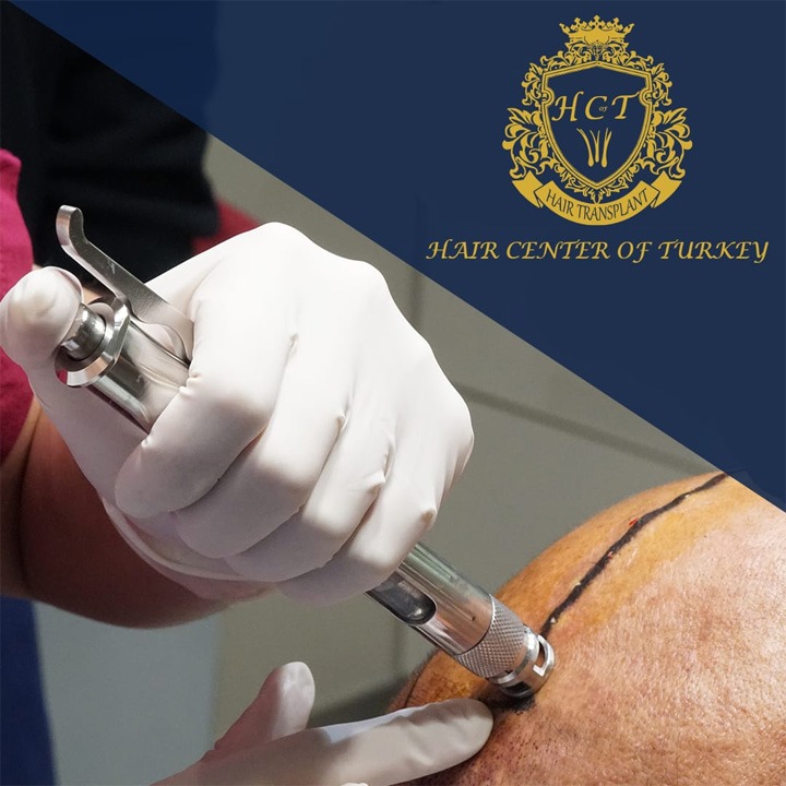 Hair Center of Turkey’de ağrısız ve tıraşsız saç ekimi ayrıcalıklarını yaşayın