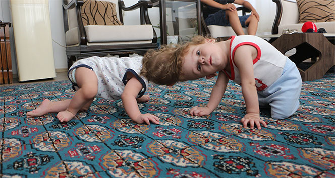 Antalyalı siyam ikizleri ayrıldı