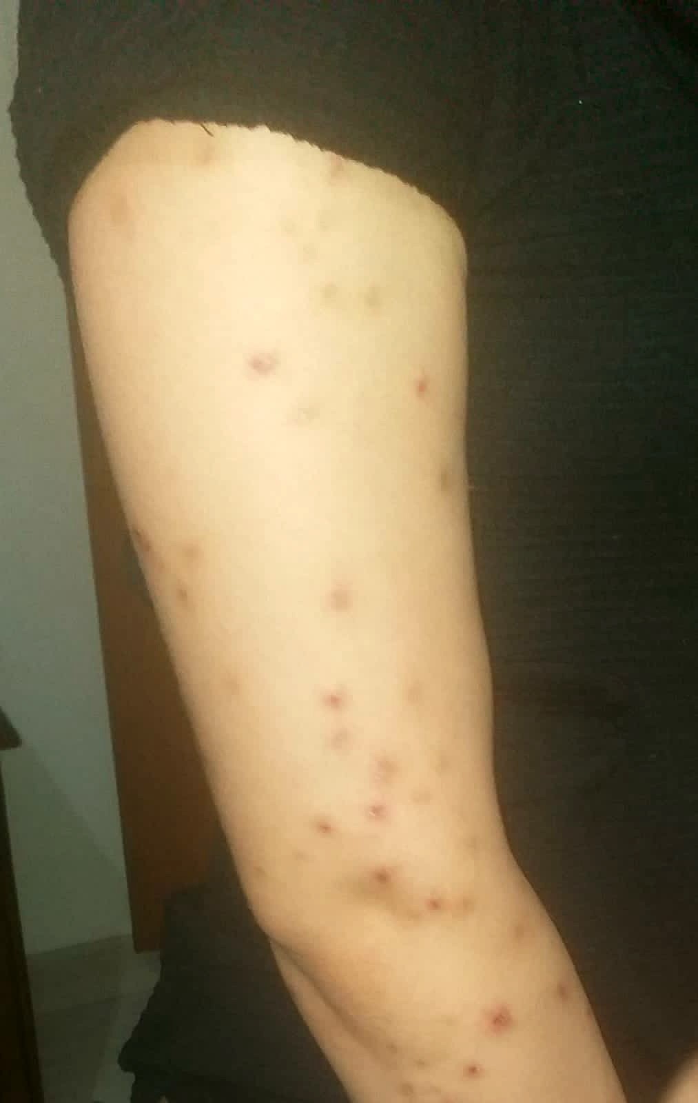 Burun estetiği kabusu oldu