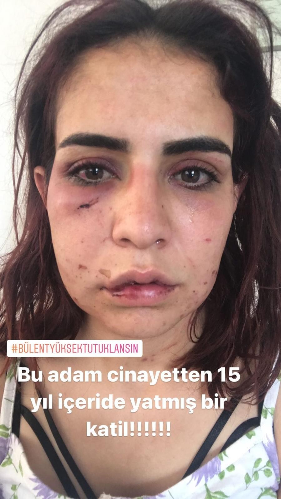 Sevgilisi tarafından darp edilen Beyza: “Başkaları gibi ölmek istemiyorum”