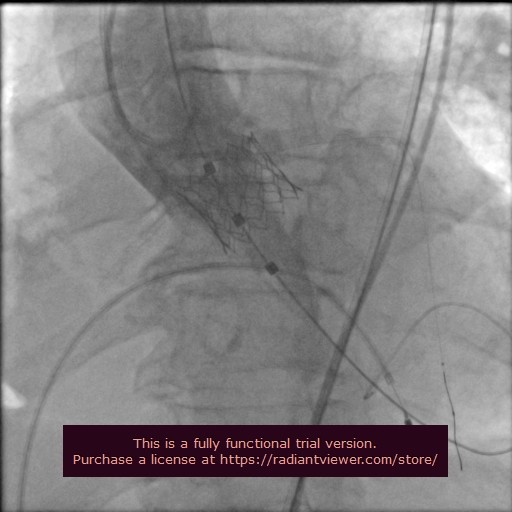 Ameliyatsız kalp kapağı değişimi
