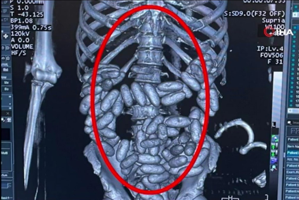 İstanbul Havalimanı'nda yolcunun midesinde 2 kilo uyuşturucu çıktı