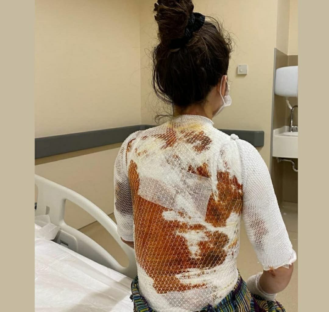 Eşinin kaynar suyla yaktığı Rukiye A: 'Ölmek istemiyorum'