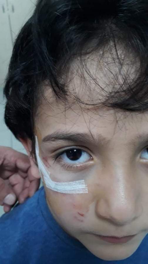 Sokak köpeği 8 yaşındaki Mehmet'in yanağını koparıyordu!