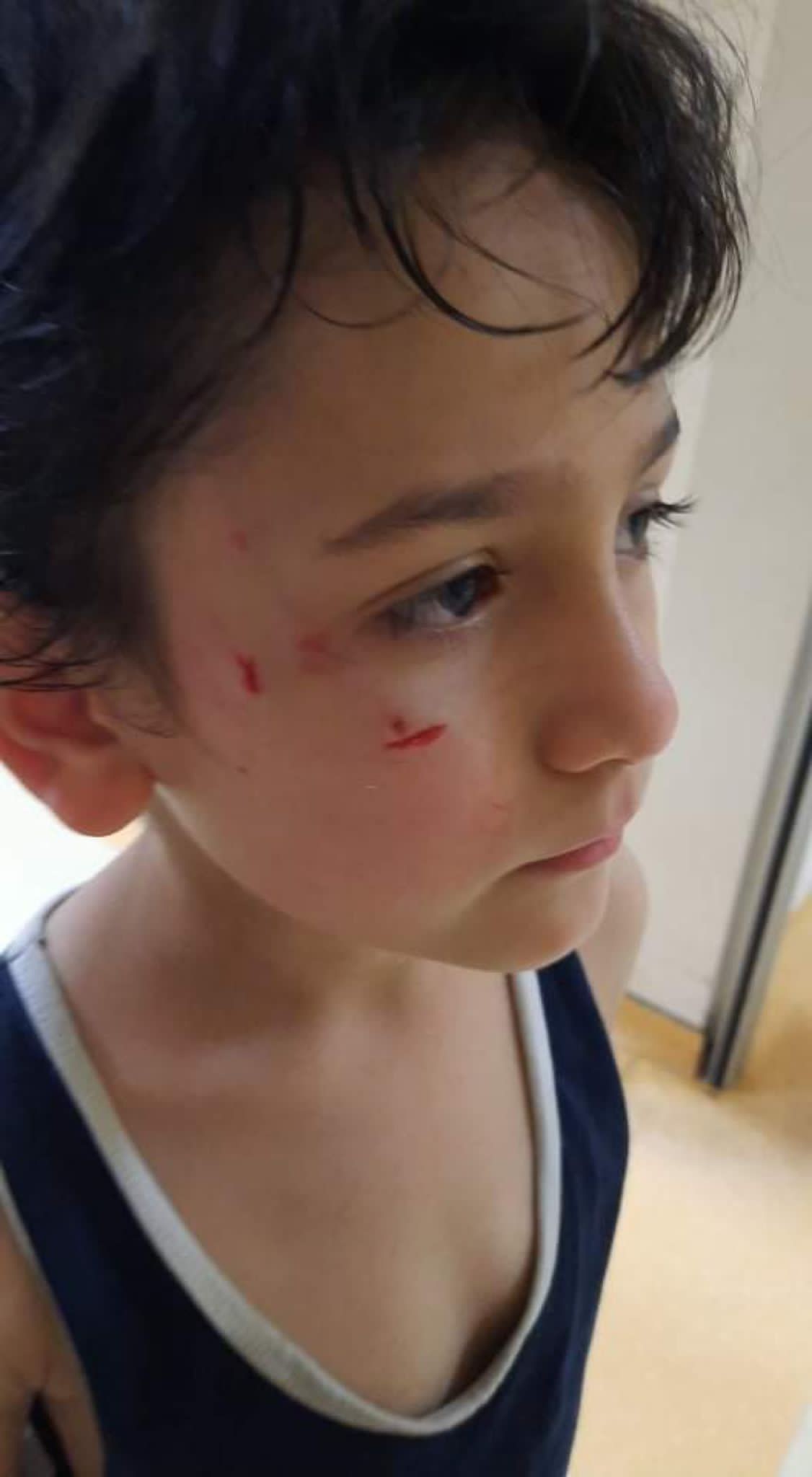 Sokak köpeği 8 yaşındaki Mehmet'in yanağını koparıyordu!