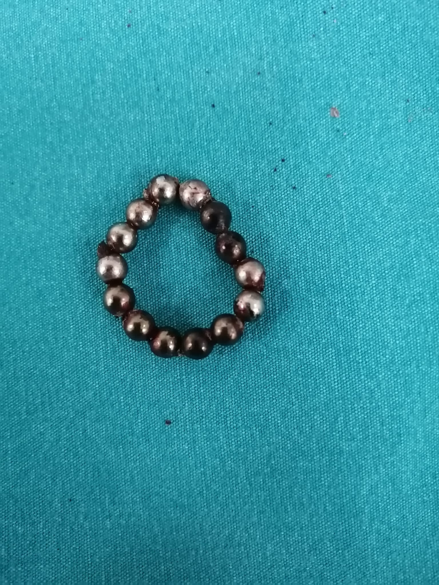 14 tane mıknatıs yutan çocuğun 8 yerden bağırsağı delindi