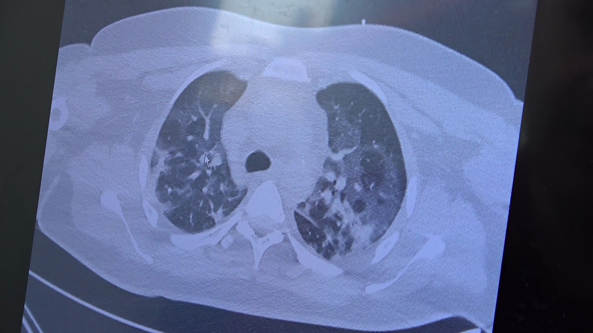 Aşısız gençler ve delta varyantı hasta profilini değiştirmeye başladı