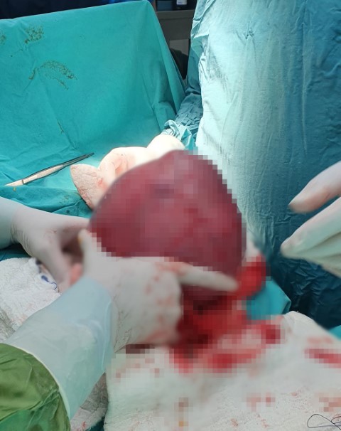 Tıpta nadir durum: Karnından 20 santim büyüklüğünde miyom çıktı