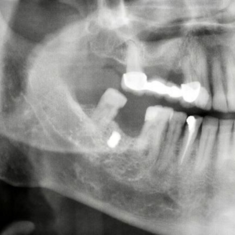 Damağına saplanan kurşun büyüklüğündeki demir parçasından 15 yıl sonra haberdar oldu