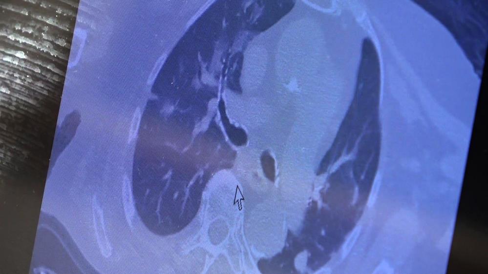 Kovid-19'da yeni hasta profili: 'Aşı oldum hastalandım'