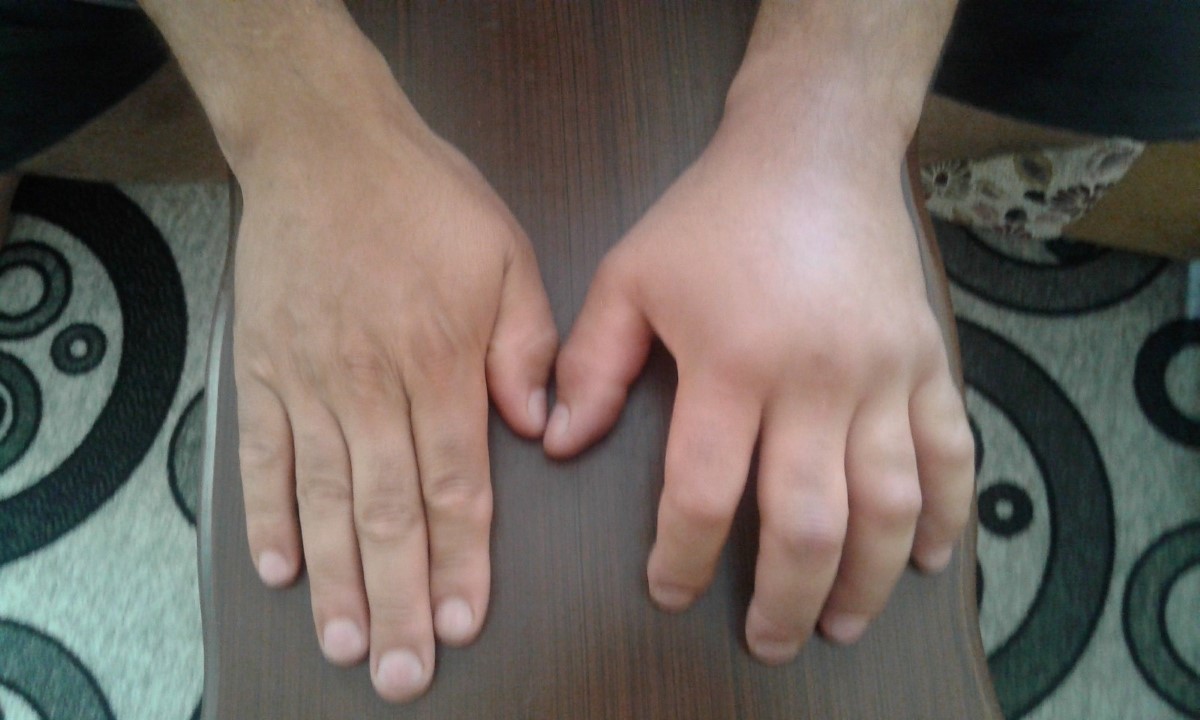 Türkiye’de tanınmayan hastalık: Alerji mi, Herediter Anjiyoödem mi?