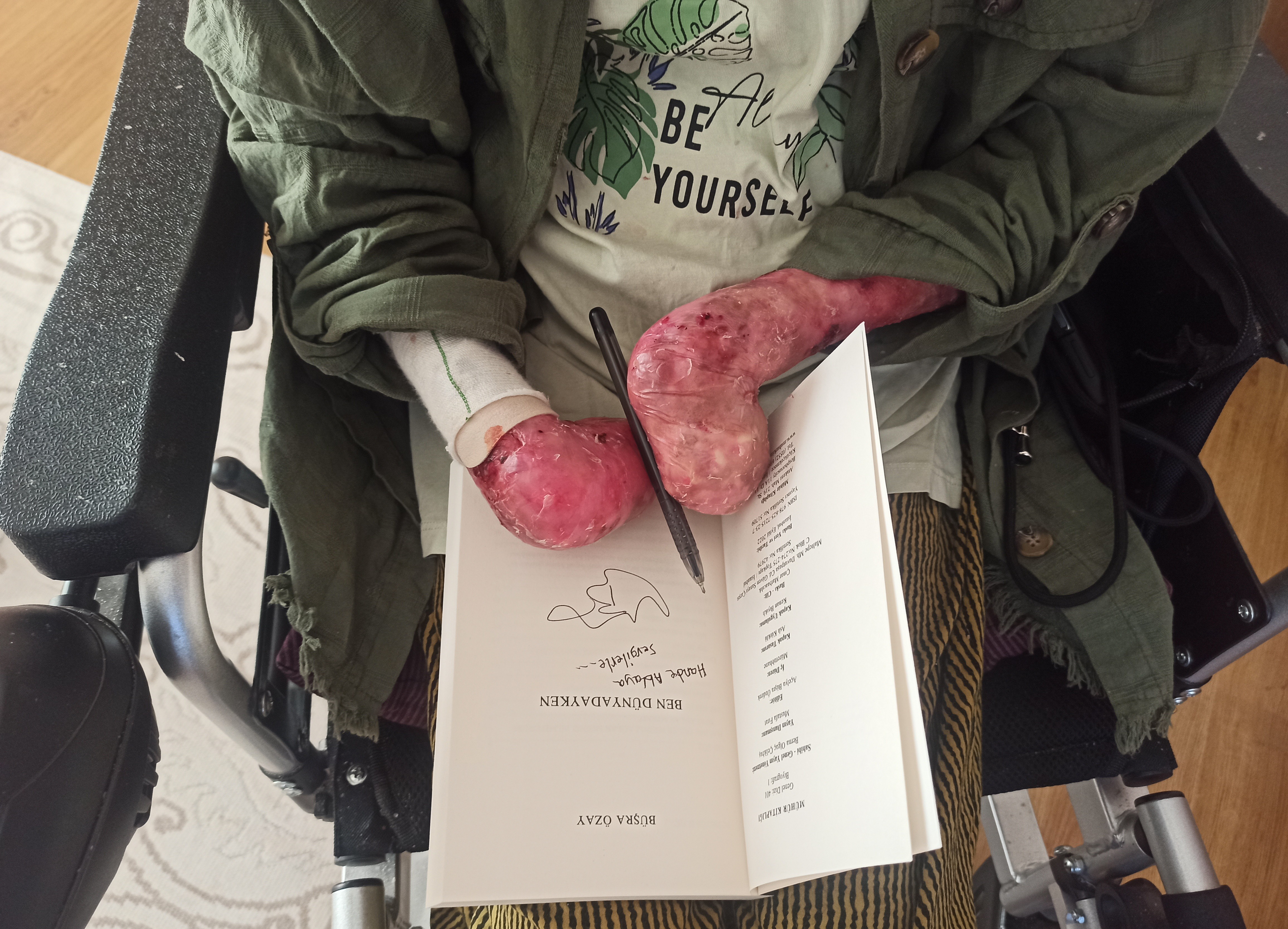 Kelebek hastası Büşra günlüklerini kitap haline getirdi