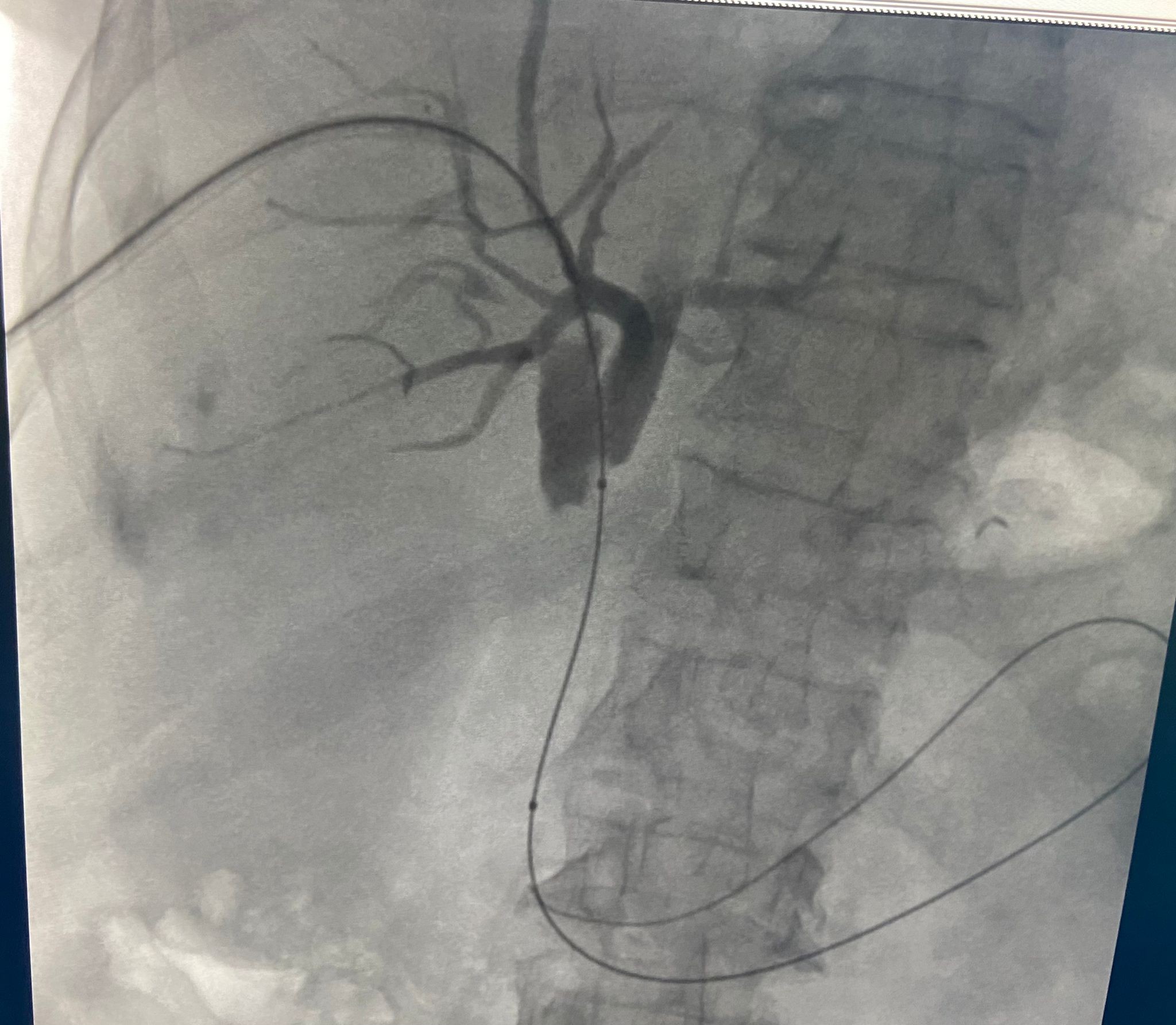 Prof. Dr. Ercan Kocakoç: 'Safra yolu kanserinin ameliyatsız tedavisi mümkün'