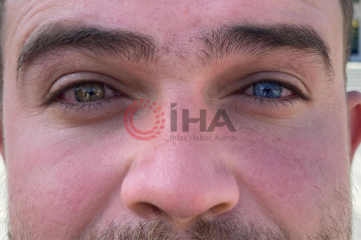 Bir gözü mavi, bir gözü yeşil olan adamı gören şaşırıyor