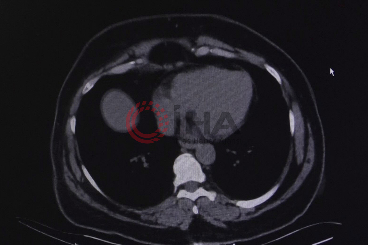 KOAH ataklarına dikkat: 'Şikayetleri sigaraya bağlayarak doktora geç başvuruyorlar'