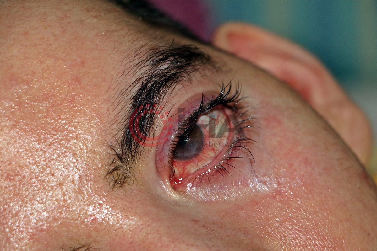 10 yıldır gözlerini bir kez bile kırpamayan Halil, adeta kan ağlıyor