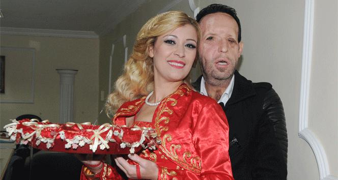 Beşinci yüz nakilli Recep Sert baba oluyor antalya,Yüz nakli yapılan Recep Sert,Yüz nakli yapılan Recep Sert baba oluyor