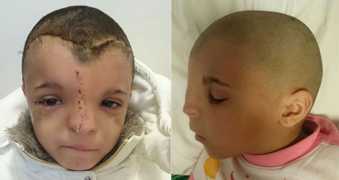 Iraklı küçük kız, yeni yüzüne Türkiyede kavuştu