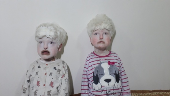 Albino kardeÅler yardÄ±m bekliyor | Albino hastalÄ±ÄÄ± nedir?